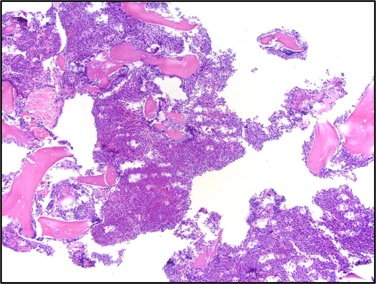 Bone marrow core biopsy demonstrates blasts arranged in sheets comprise the majority of the marrow cellularity.